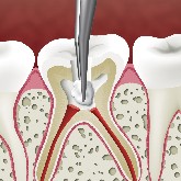 Pulpotomy Treatment