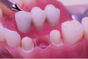 dental_bridge_proper_design