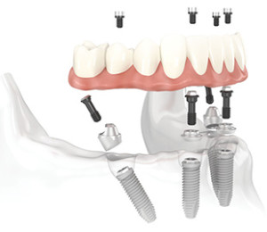 All-on-4 Technique Dental Implants 