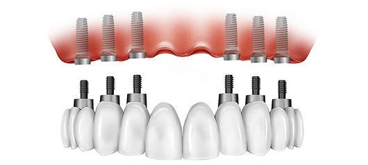 all on 6 dental implants in Hyderabad