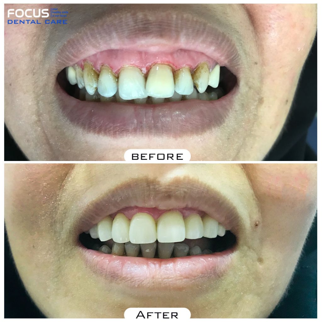 Focus Dental | Single-Visit Gummy Smile Correction in Hyderabad