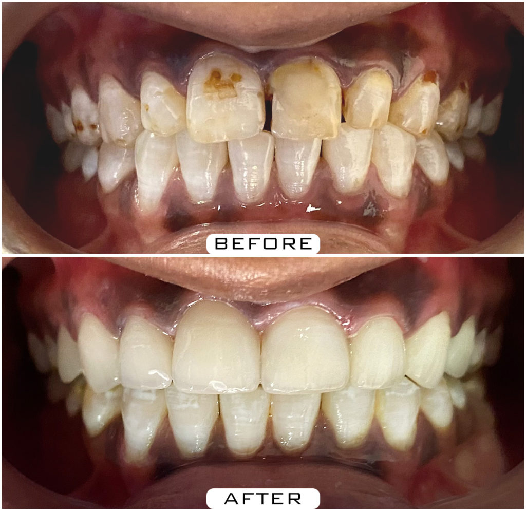 Dental Veneers in Hyderabad