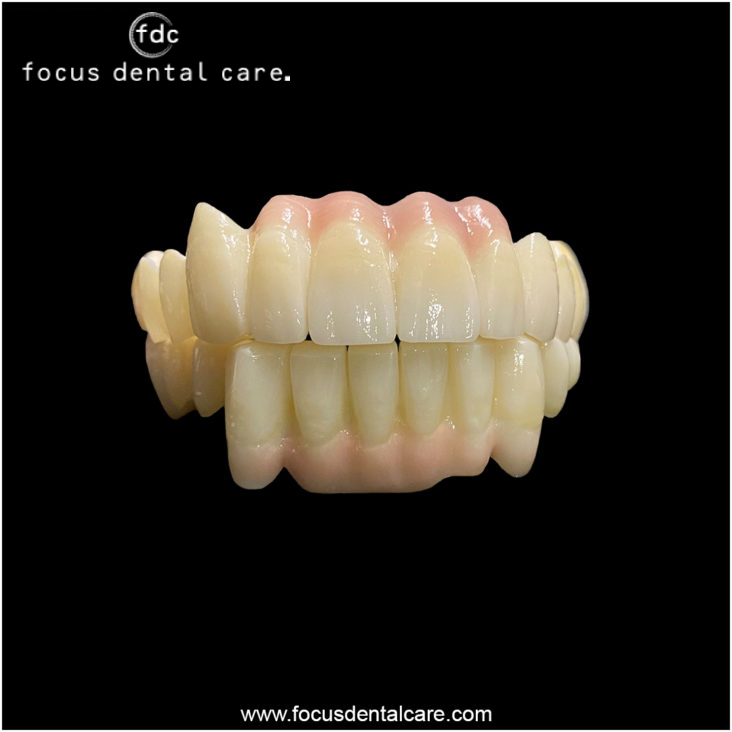 Zirconia-Bridges-in-Hyderabad