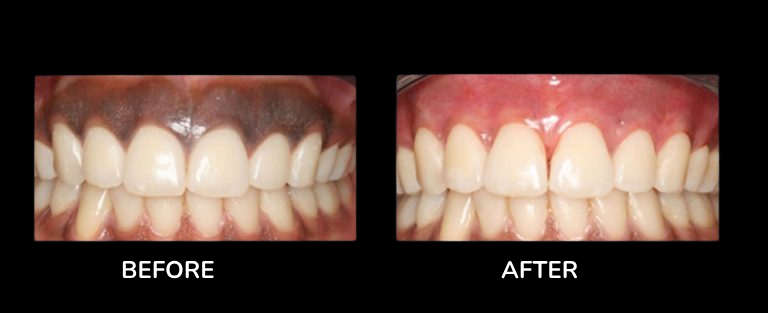 Gum depigmentation